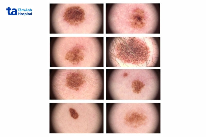 hình ảnh nhận biết u hắc tố da lành tính