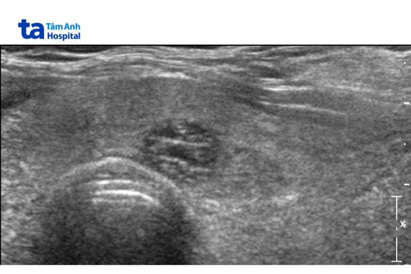 hình ảnh nhân bọt biển tuyến giáp trên siêu âm