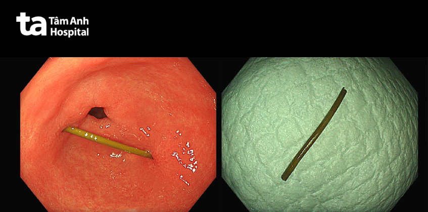 hình ảnh nội soi dị vật