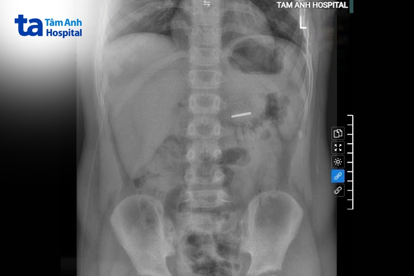 hình ảnh phim X-quang xác định khối nam châm trong dạ dày