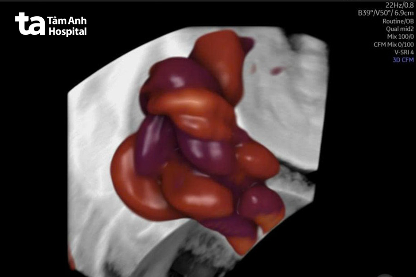 hình ảnh siêu âm dây rốn bị thắt 1 nút