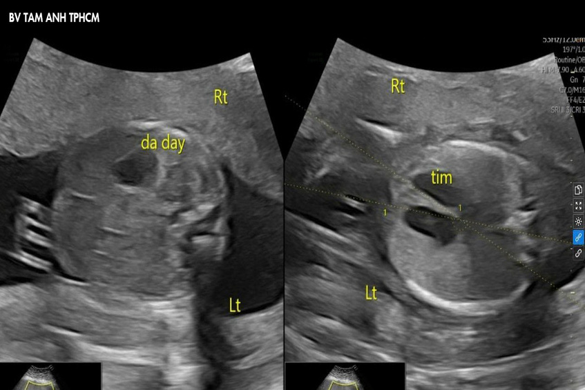 hình ảnh siêu âm thai nhi bị đảo ngược phủ tạng