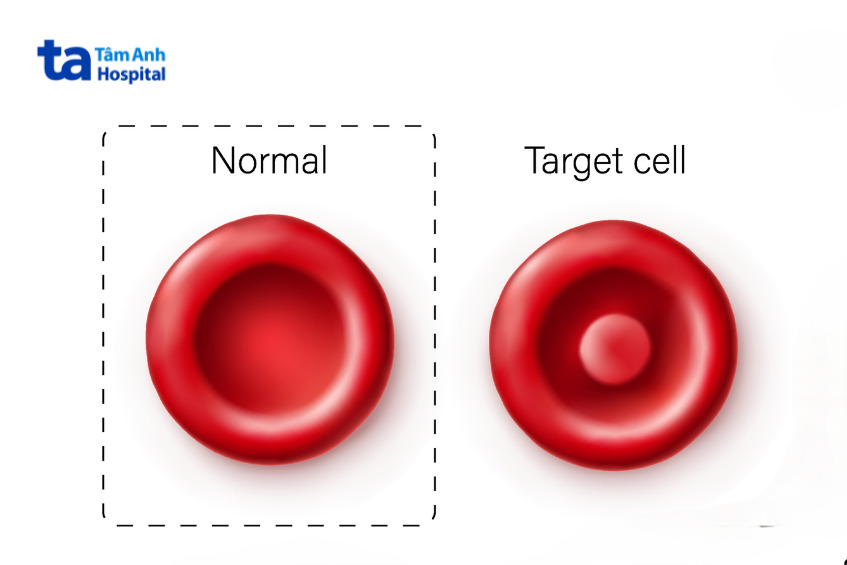 hình ảnh so sánh giữa hồng cầu hình bình thường và hồng cầu bia