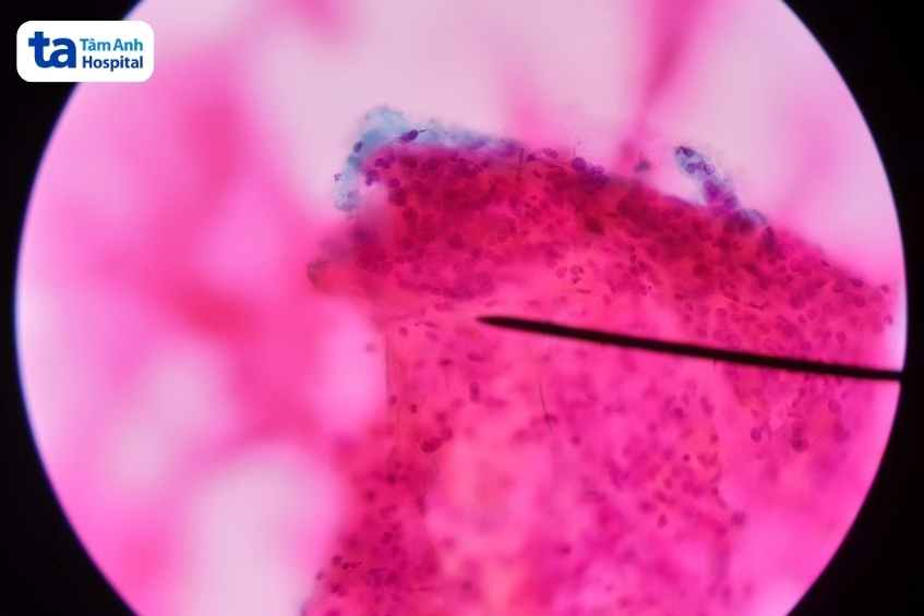 hình ảnh tế bào ái toan hurthle dưới kính hiển vi