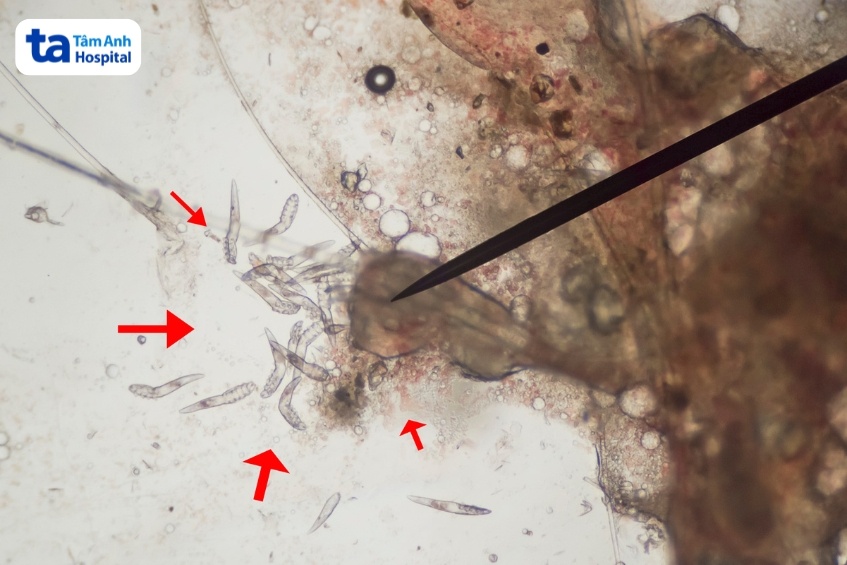 hình ảnh ve demodex dưới kính hiển vi