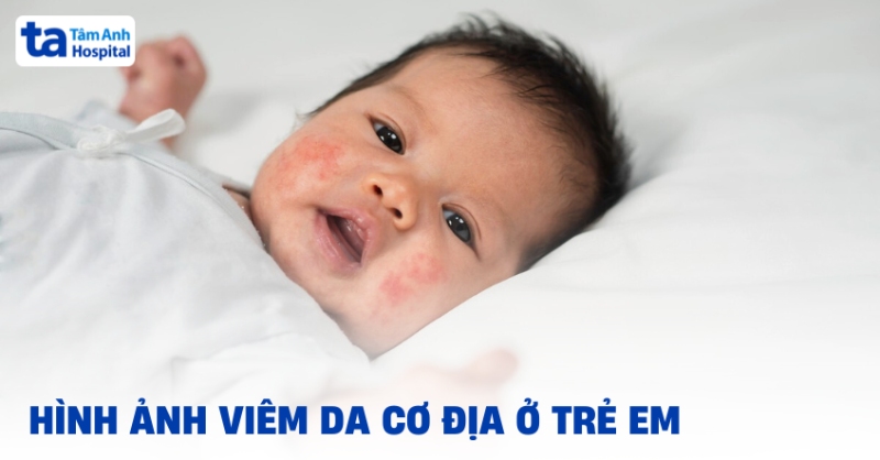 18 hình ảnh viêm da cơ địa ở trẻ em, sơ sinh từng giai đoạn, vị trí