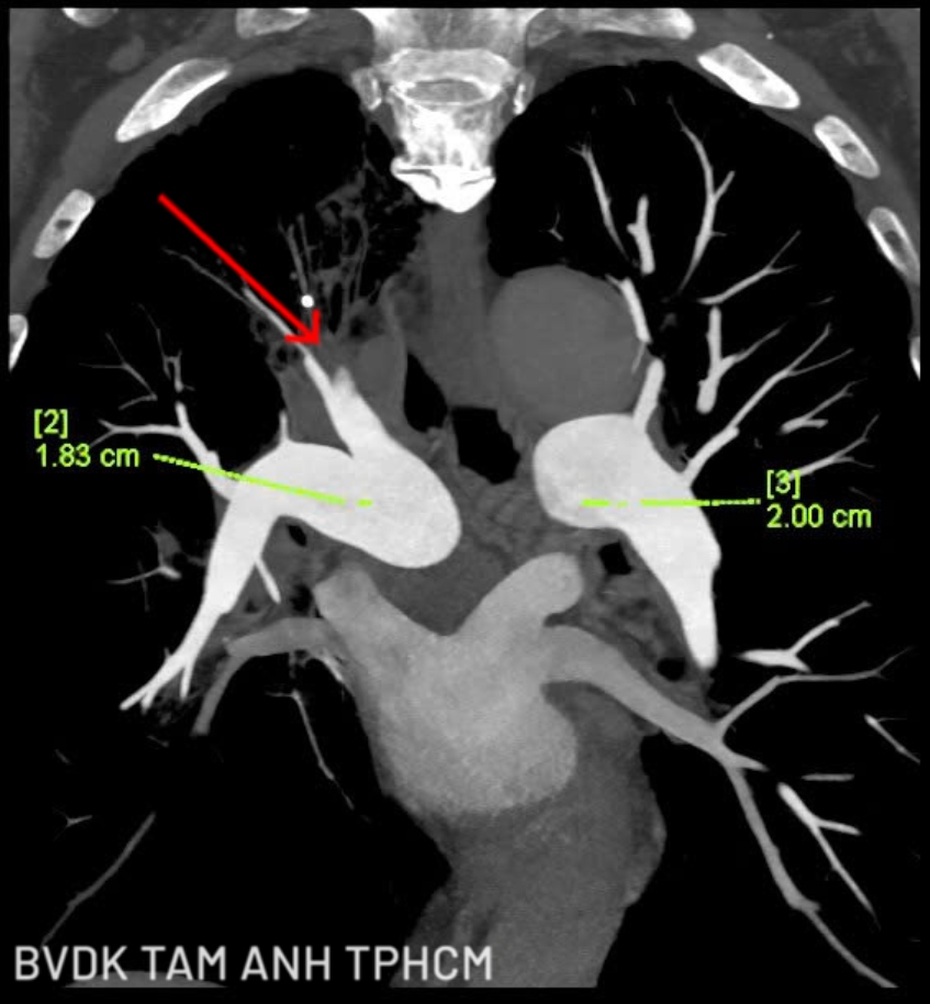 hình chụp ct ngực cho thấy huyết khối