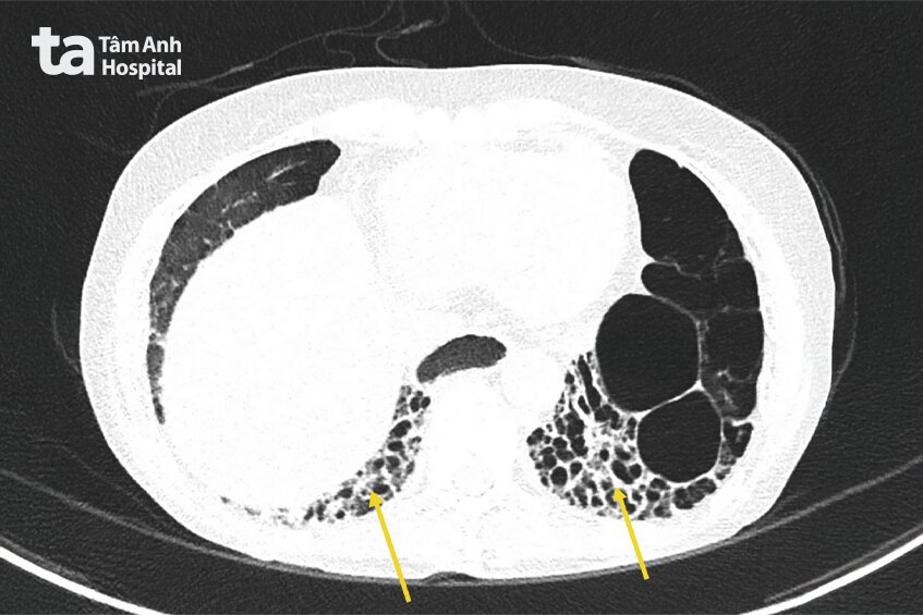 hình chụp ct phổi