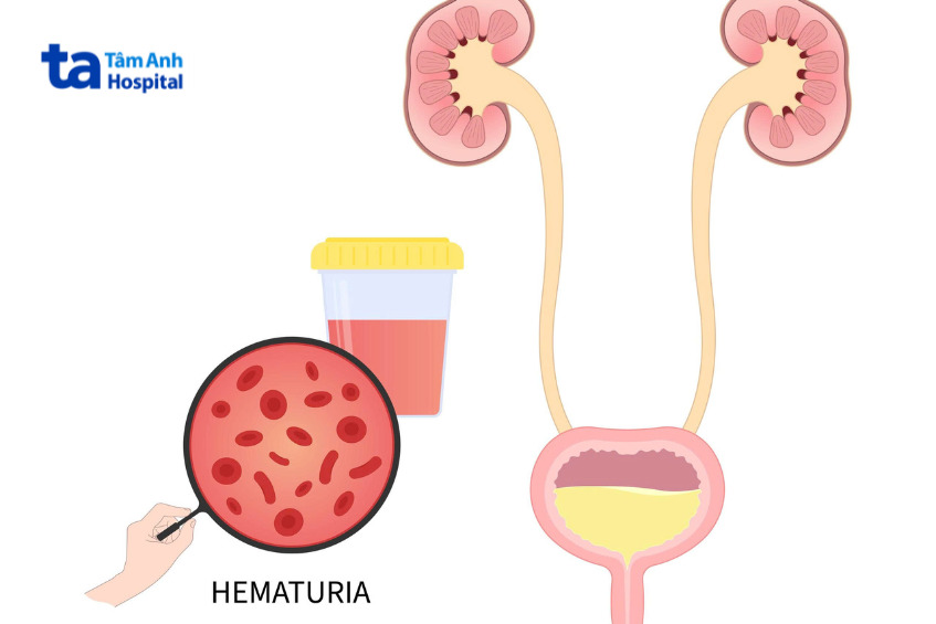 hình minh họa hồng cầu trong nước tiểu