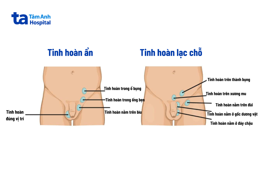 Hình minh họa cách phân biệt tinh hoàn lạc chỗ và tinh hoàn ẩn