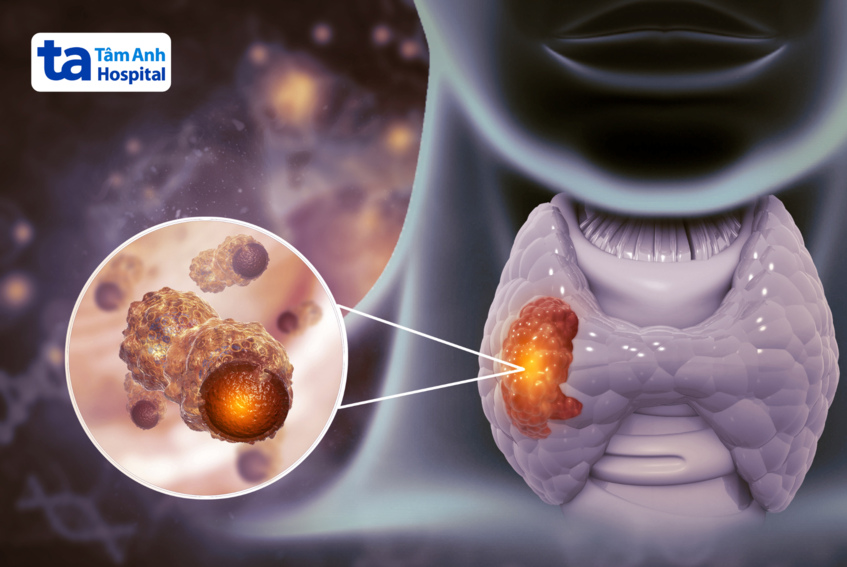 hình minh họa ung thư tuyến giáp thể biệt hóa