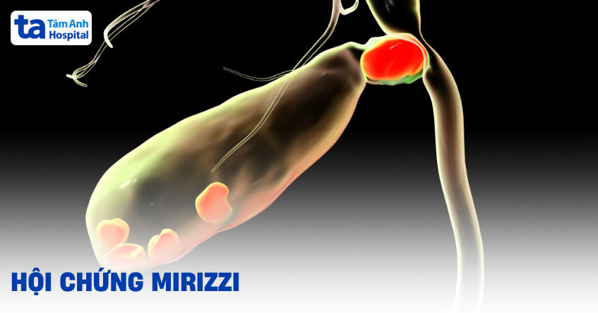 Hội chứng Mirizzi: Cơ chế bệnh sinh phức tạp, chẩn đoán khó khăn