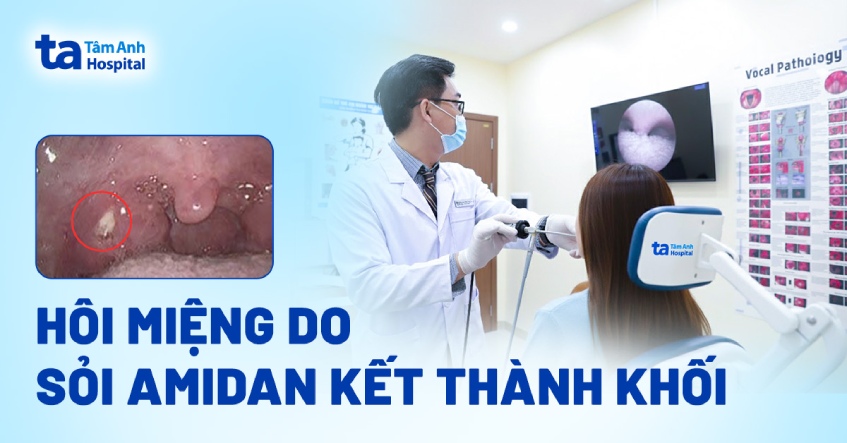 hôi miệng do sỏi amidan