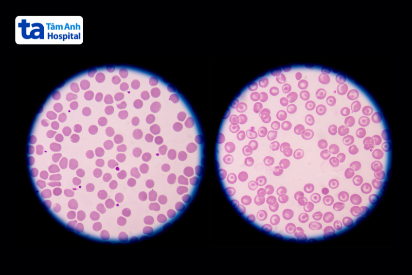hồng cầu bình thường (bên trái) và hồng cầu hình bia bắn (bên phải)