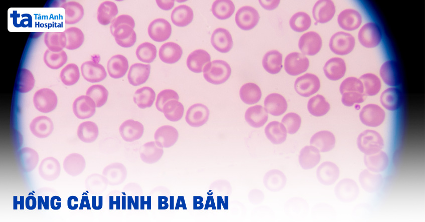 Hồng cầu hình bia bắn: Bất thường nhưng có đáng lo?
