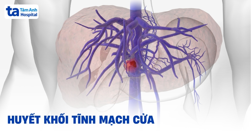 Tổng quan về huyết khối tĩnh mạch cửa: Ảnh hưởng gì đến gan?