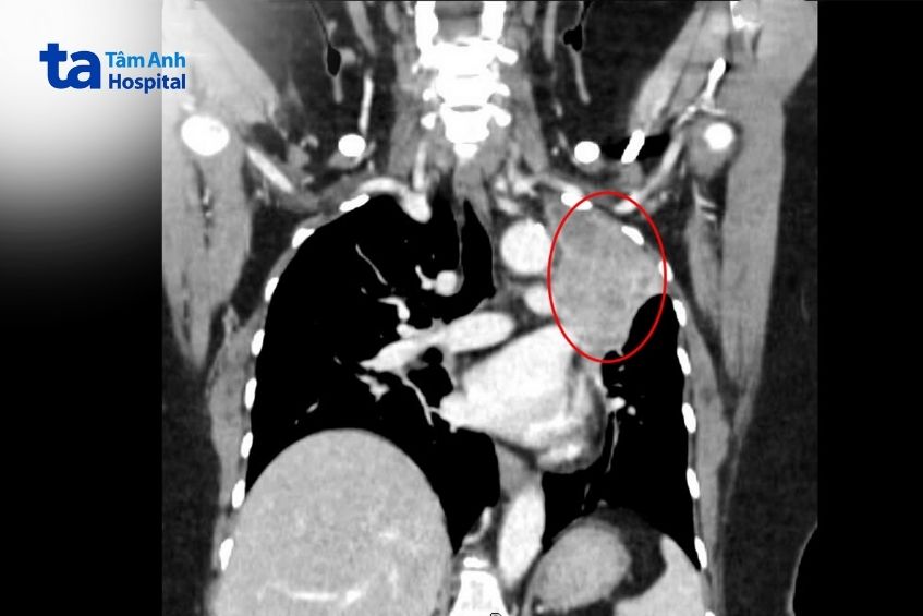 kết quả chụp ct thấy phổi có khối u hơn 7cm.