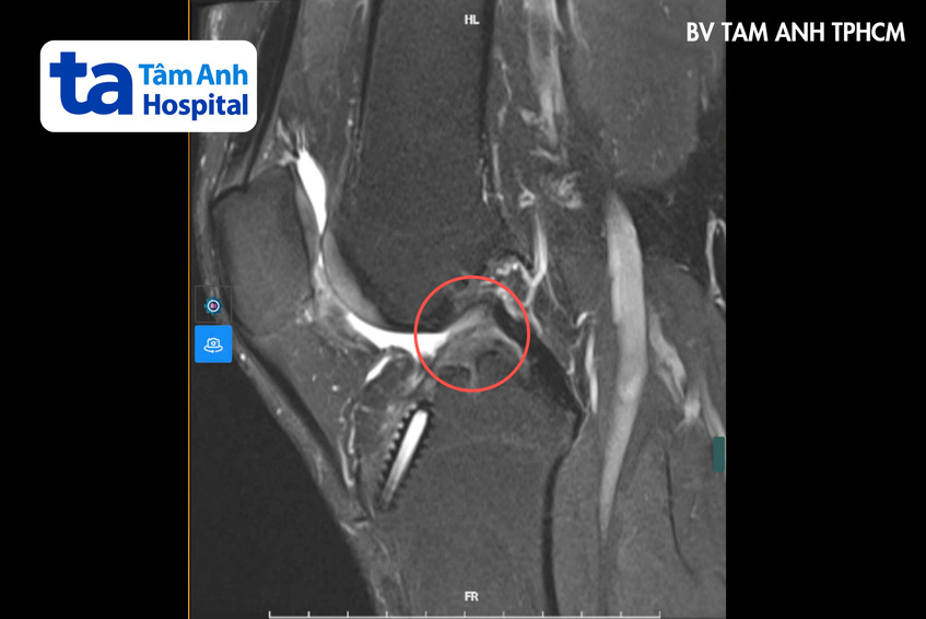 kết quả chụp MRI cho thấy dây chằng chéo trước đã đứt hoàn toàn