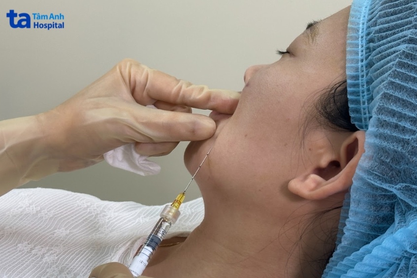 khách hàng tiêm filler lại tâm anh