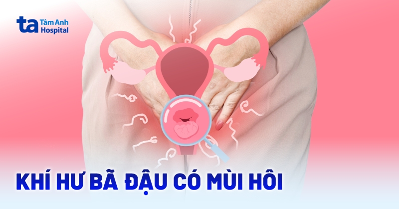 Ra khí hư bã đậu có mùi hôi là bệnh gì? Nguyên nhân, cách điều trị