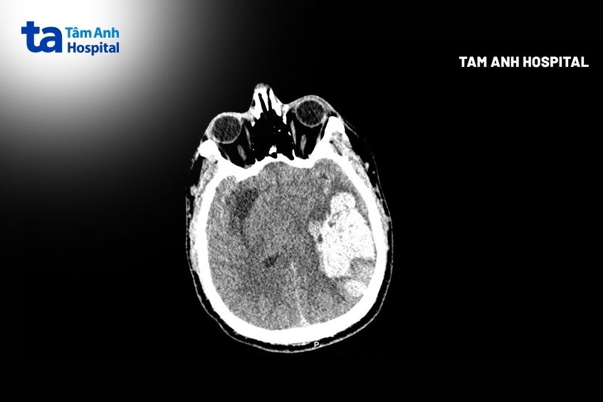 khối máu tụ tại thùy thái dương đỉnh trái