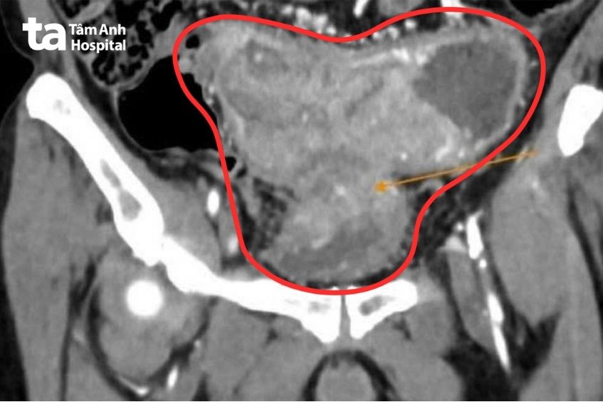 khối u ác tính gây hẹp hoàn toàn lòng ruột
