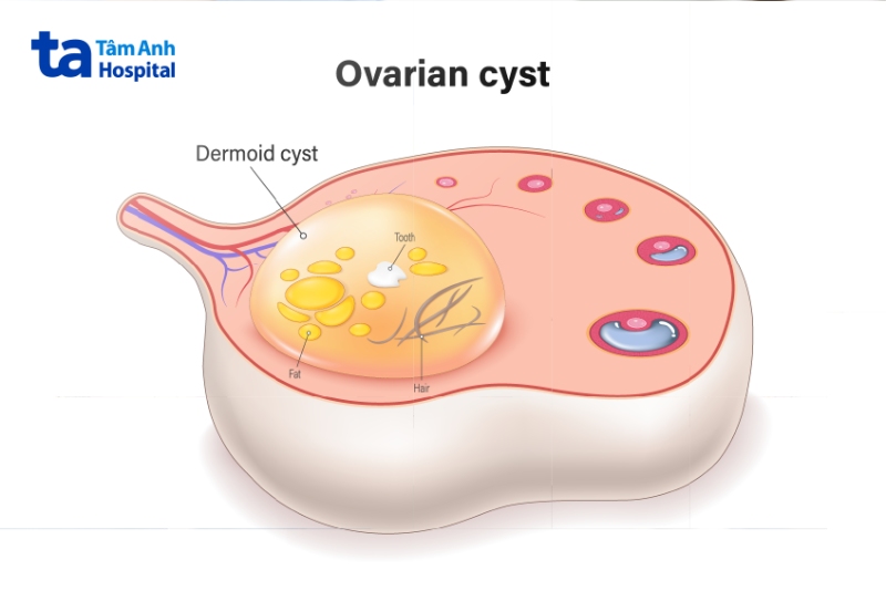 khối u bì ở buồng trứng
