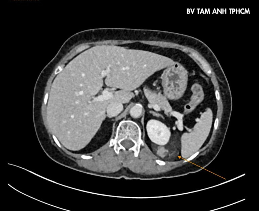 khối u cơ mỡ của người bệnh