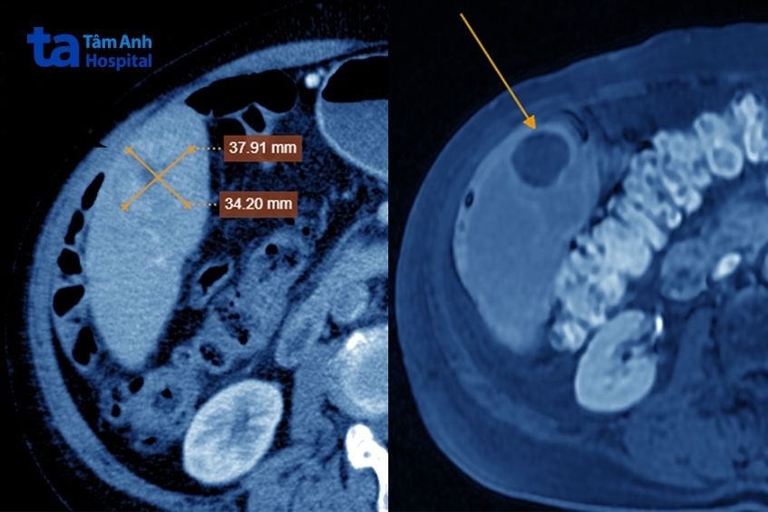 khối u gan của bệnh nhân
