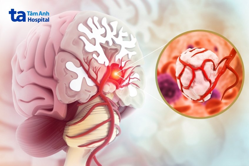 khối u não lành tính vẫn có thể được chỉ định xạ trị nếu cần thiết