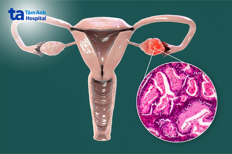 khối u ở buồng trứng