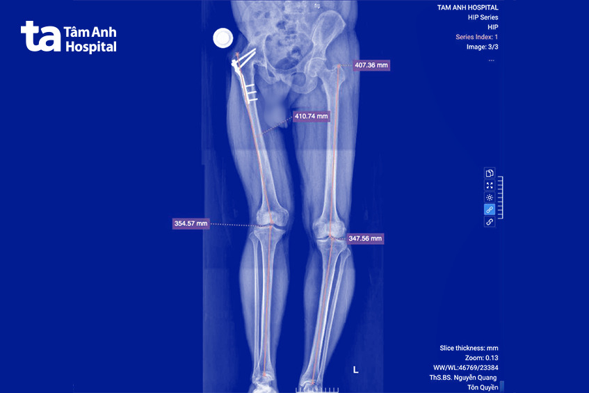khớp háng phải của anh Giang bị đóng cứng