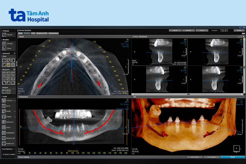 kỹ thuật CT răng