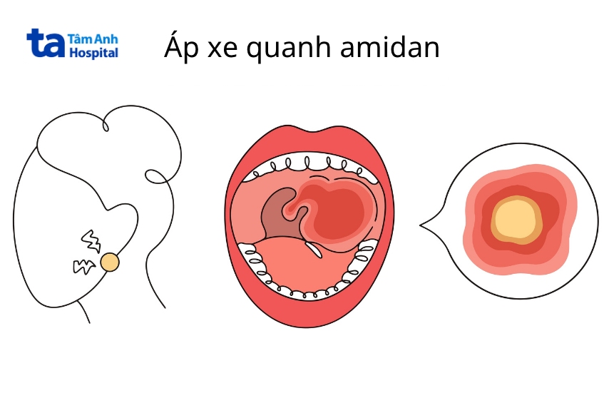 loại bỏ áp xe quanh amidan