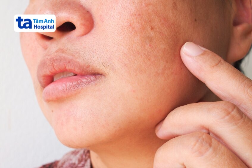 loại nám ảnh hưởng đến kết quả điều trị bằng peel da