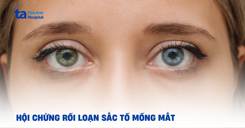 Tất cả thông tin về chứng loạn sắc tố mống mắt