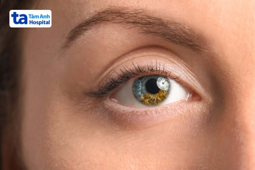 loạn sắc tố mống mắt xảy ra trên cùng một mắt