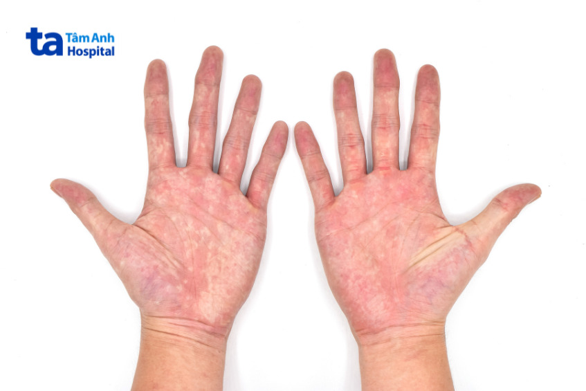 lòng bàn tay người bệnh bệnh đa hồng cầu nguyên phát