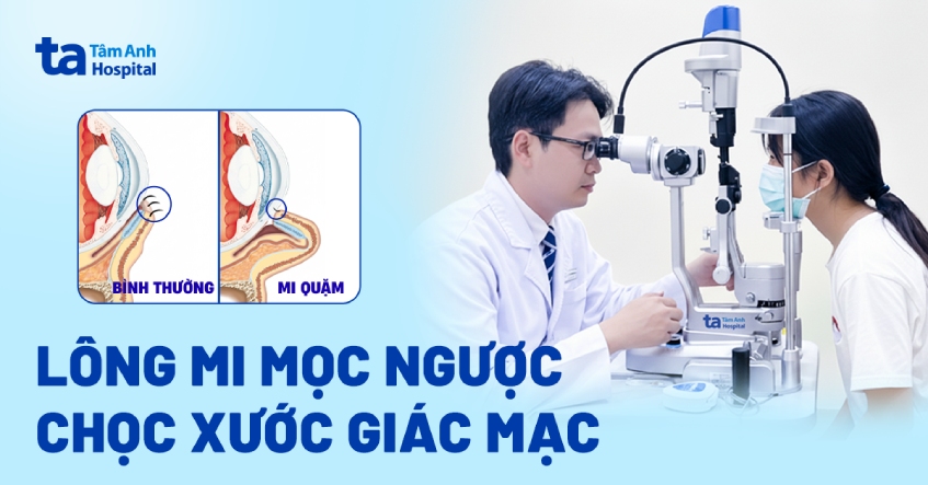 Lông mi mọc ngược chọc xước giác mạc