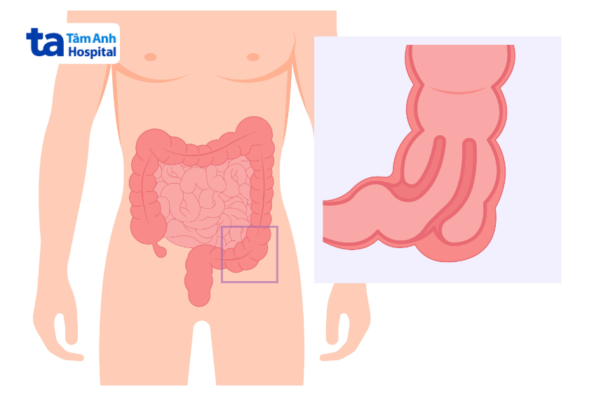 lồng ruột người lớn