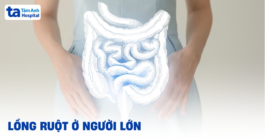 Tìm hiểu về lồng ruột ở người lớn diễn ra như thế nào?