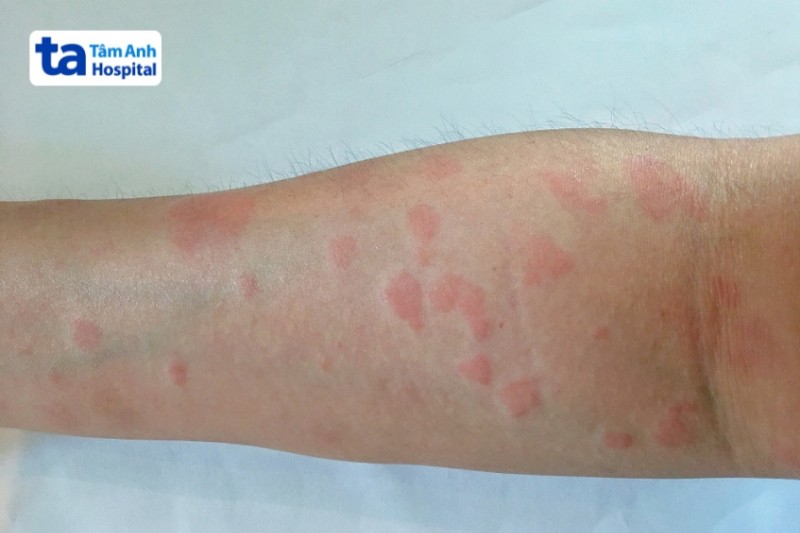 phát ban da do lupus thuốc