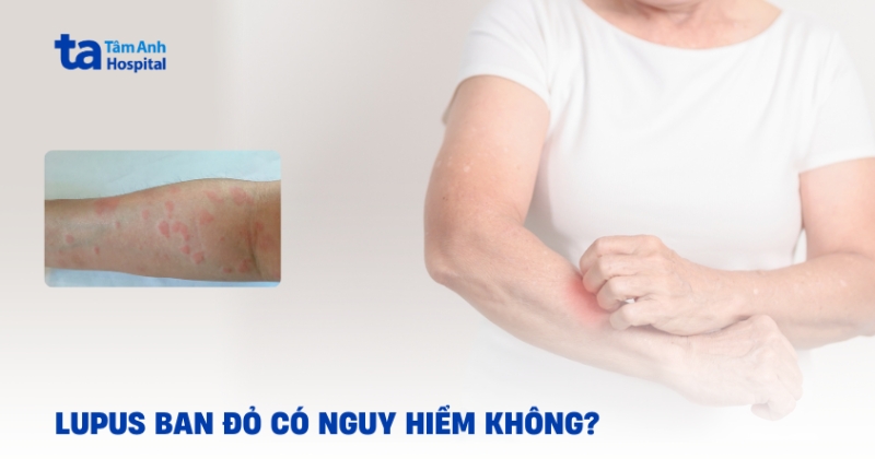 Lupus ban đỏ có nguy hiểm không? 12 biến chứng thường gặp