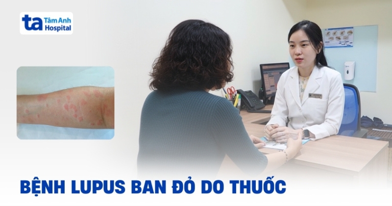 Thông tin về bệnh Lupus ban đỏ do thuốc