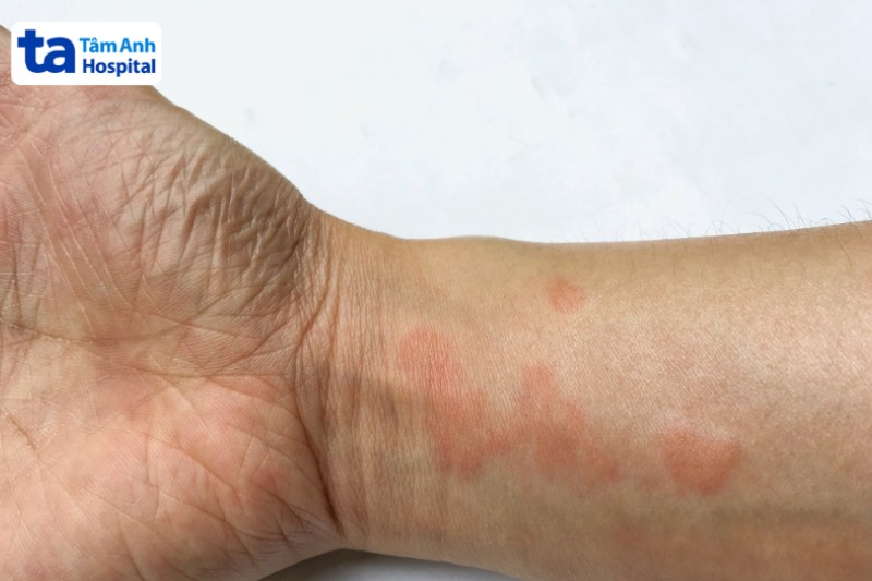 lupus ban đỏ là bệnh nguy hiểm