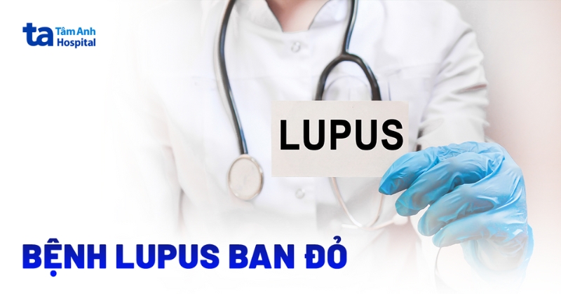 Bệnh lupus ban đỏ: Nguyên nhân, dấu hiệu, chẩn đoán và phòng ngừa