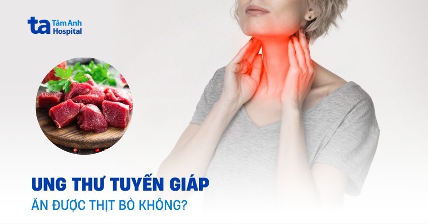 mắc ung thư tuyến giáp có ăn được thịt bò không
