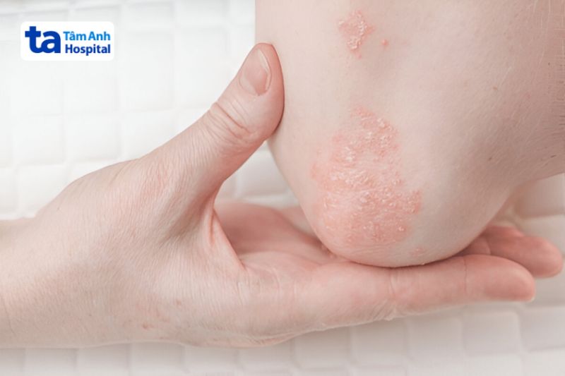 mảng đa đỏ do vảy nến
