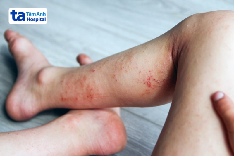 mảng đỏ sưng trên da
