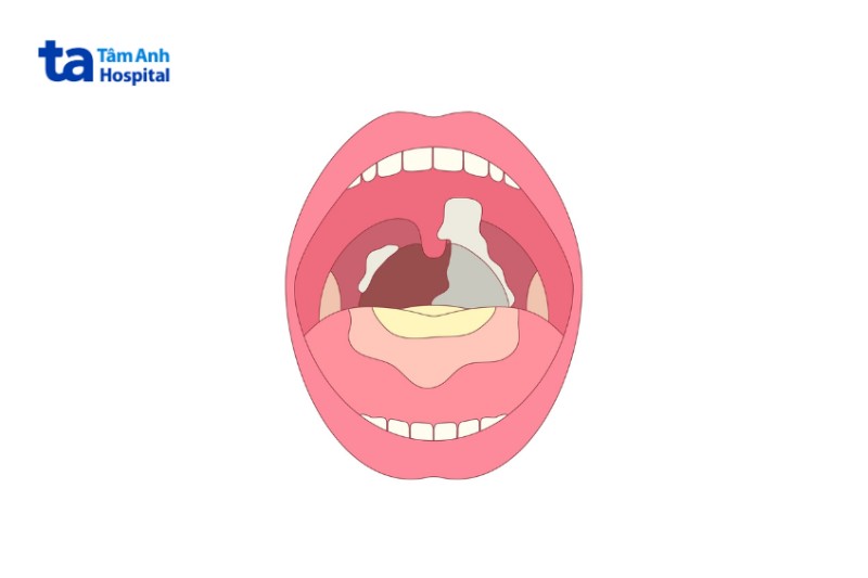 mảng trắng xám giả mạc mạch hầu